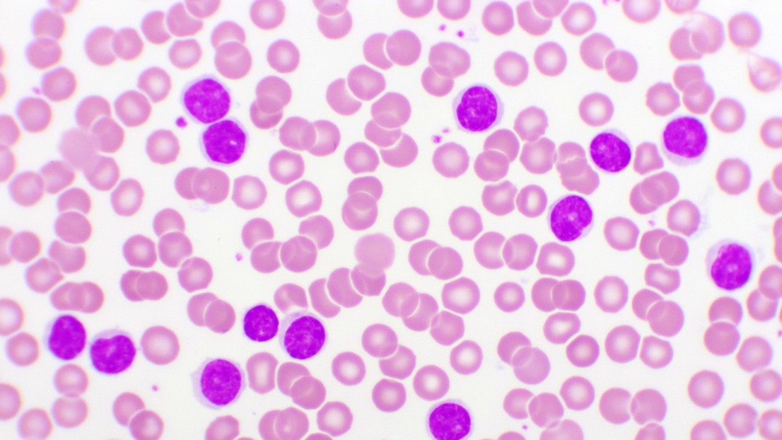 Blood smear of chronic lymphocytic leukemia (CLL), analyze by microscope. EPFL/ iStock