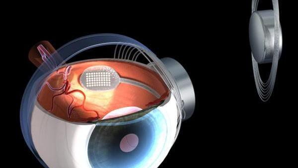 Second Sight's "Argus II" implant.