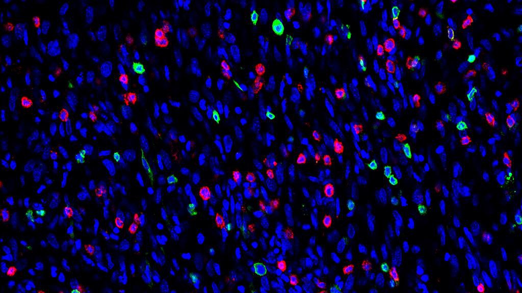 Lymphocytes (red et green) and cancer cells (blue) © M. De Palma/EPFL