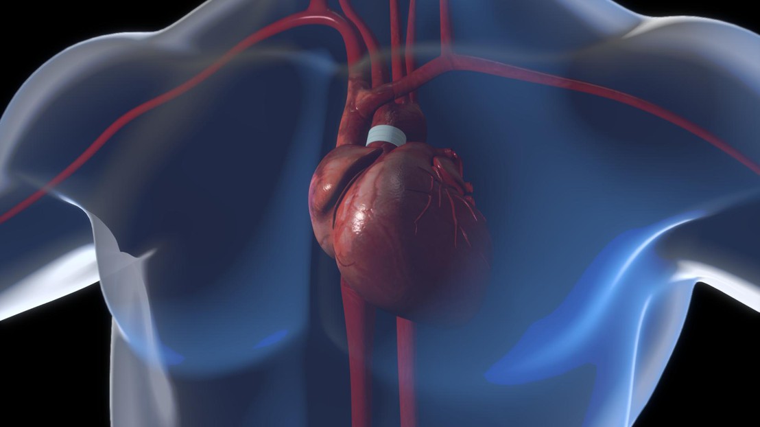 The system consists in three rings placed around the aorta. © 2016 EPFL/ J.Caillet The system consists in three rings placed around the aorta. © 2016 EPFL/ J.Caillet