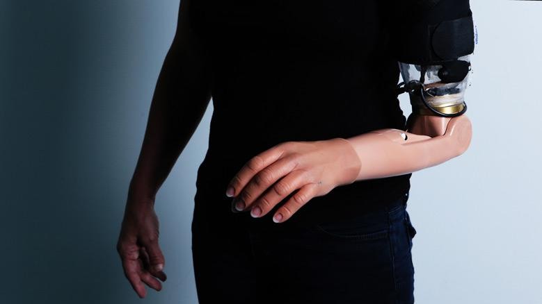 An amputee fitted with an advanced arm prosthetic following TMSR surgery (credit: Irit Hacmun, Tel Aviv) An amputee fitted with an advanced arm prosthetic following TMSR surgery (credit: Irit Hacmun, Tel Aviv)