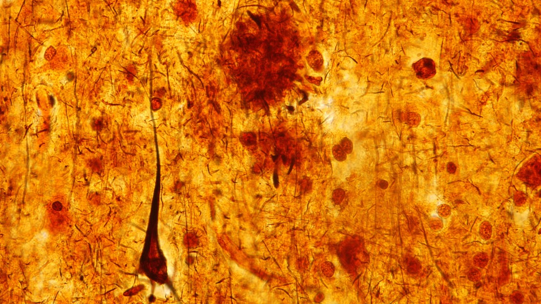 Neurofibrillary tangles (credit: Jose Luis Calvo Martin & Jose Enrique Garcia-mauriño Muzquiz/iStock)