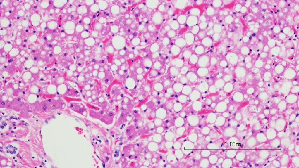 A section of liver with fatty liver disease (iStock photos)