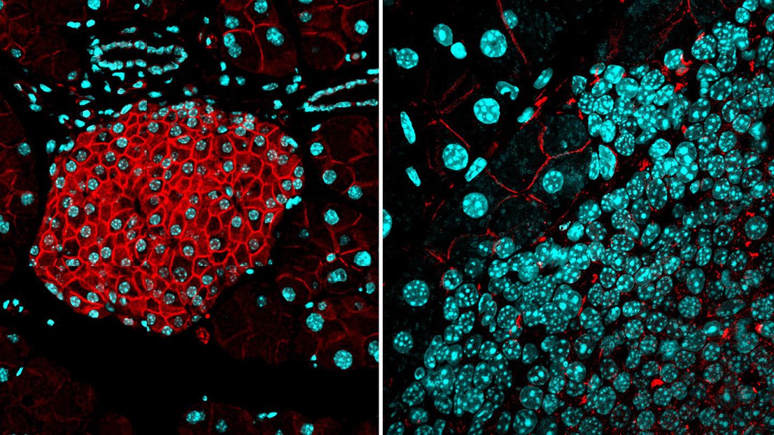 LEFT: a protective barrier of activin B expression (red) is present in normal pancreatic islets. RIGHT: the barrier is absent in islet tumors. Cyan: cell nuclei. Credit: Iacovos Michael/EPFL